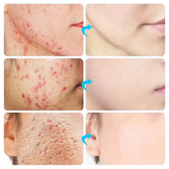 Acne Cream for Face Pimples Remover Treatment Shrink Pores Oil Control Lighten Acne Marks Whitening Smoothing Facial Skin Care