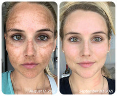 Dark Spot Correcting Cream – Advanced Pigment Removal & Melasma Treatment (EELHOE Original)